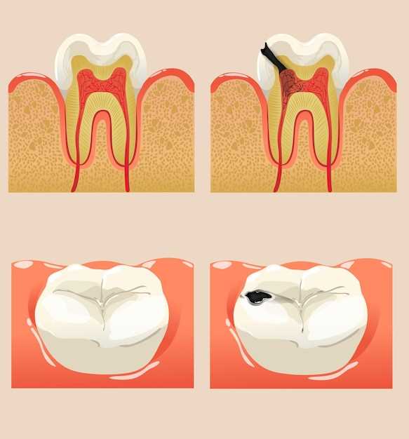 Что такое дефект в зубе?