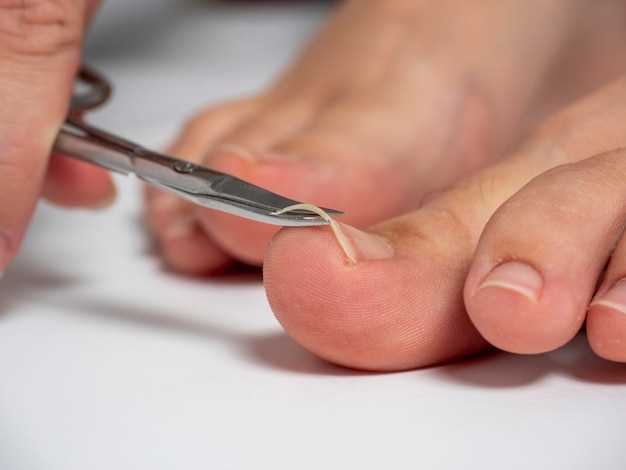 Эффективные способы лечения грибка ногтя