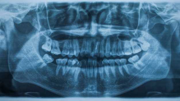 Характеристики видимой кисты на снимке зуба